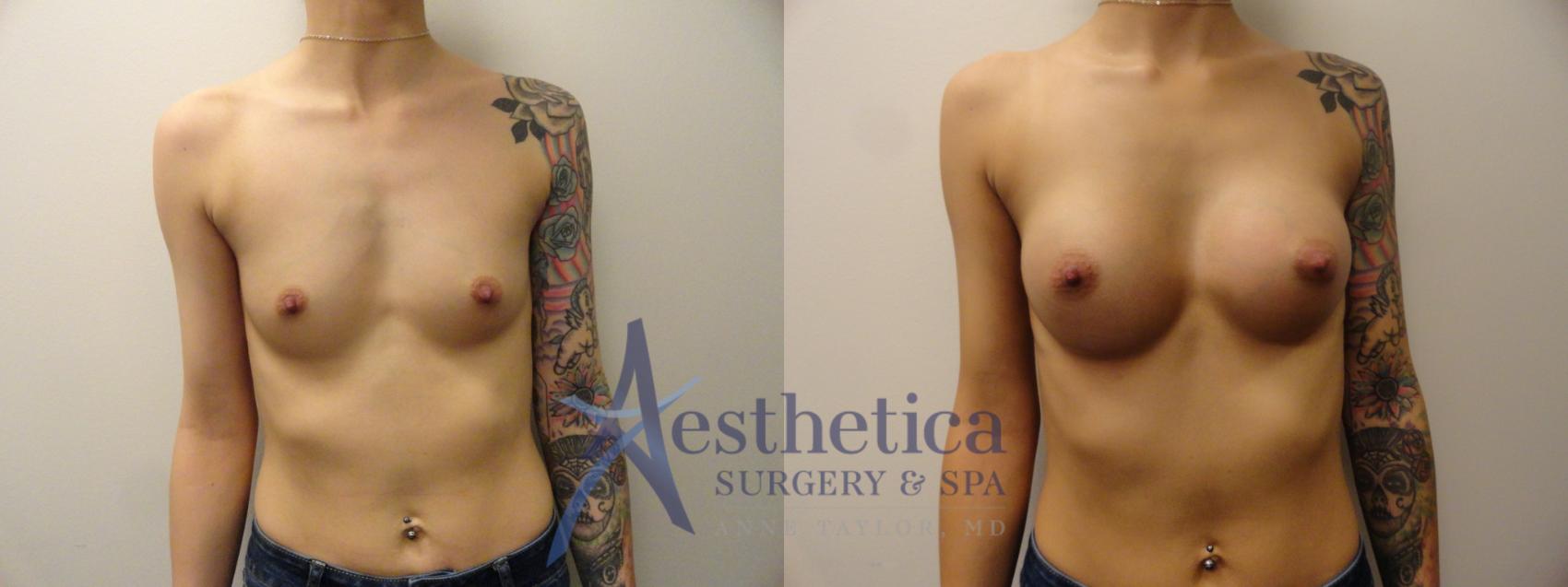 Breast Augmentation Case 388 Before & After View #1 | Worthington, OH | Aesthetica Surgery & Spa