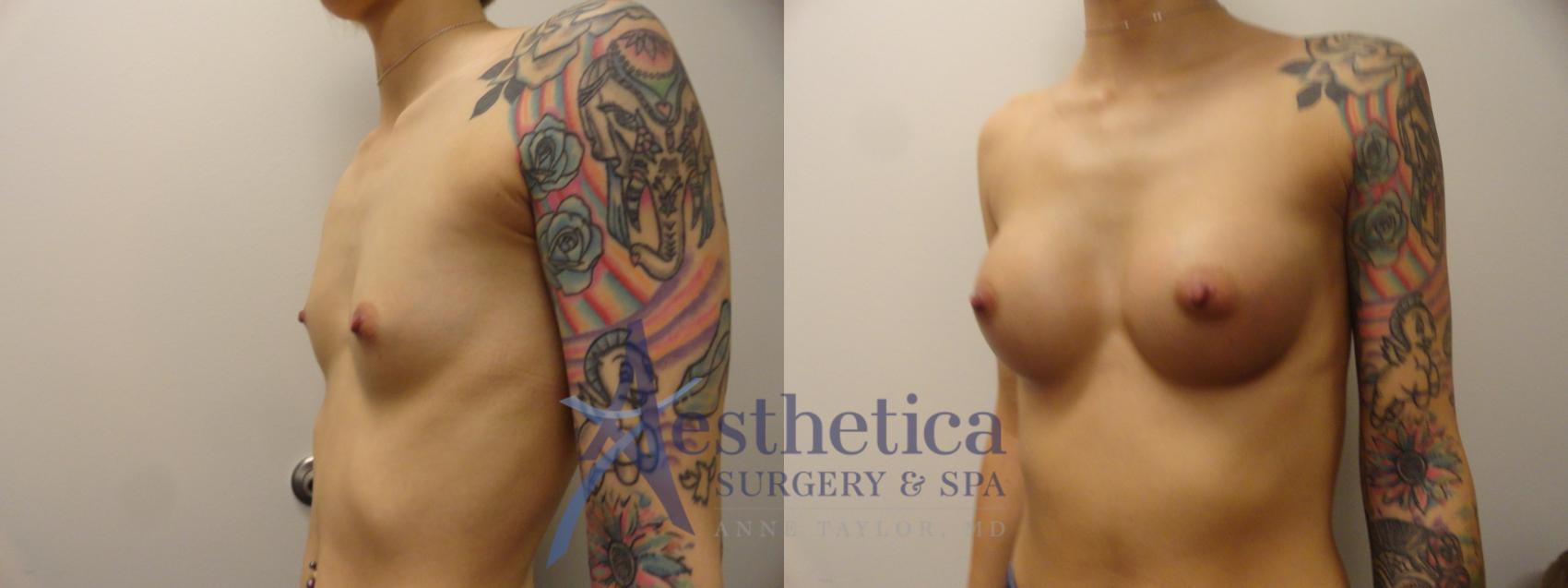 Breast Augmentation Case 388 Before & After View #2 | Worthington, OH | Aesthetica Surgery & Spa