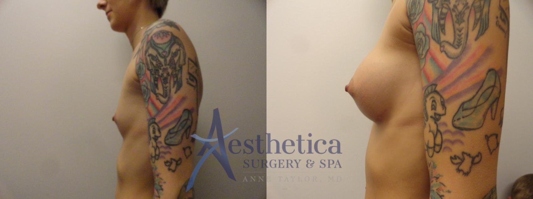 Breast Augmentation Case 388 Before & After View #3 | Worthington, OH | Aesthetica Surgery & Spa