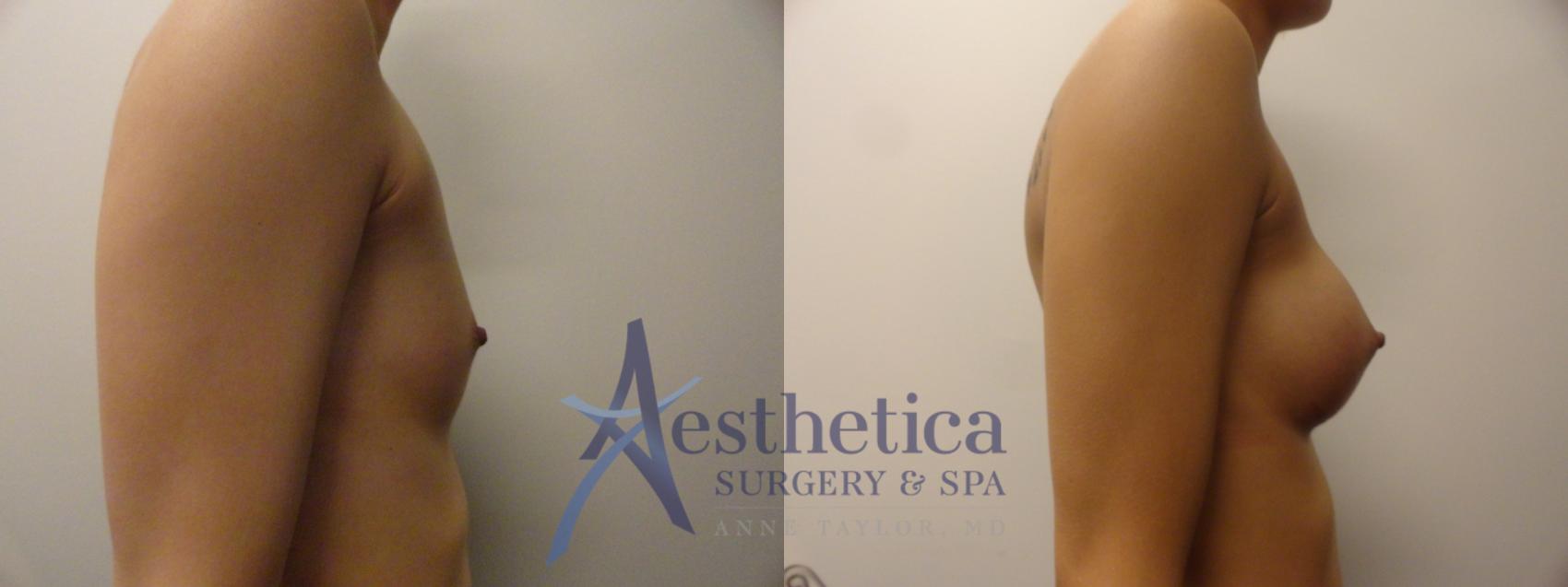 Breast Augmentation Case 388 Before & After View #4 | Worthington, OH | Aesthetica Surgery & Spa