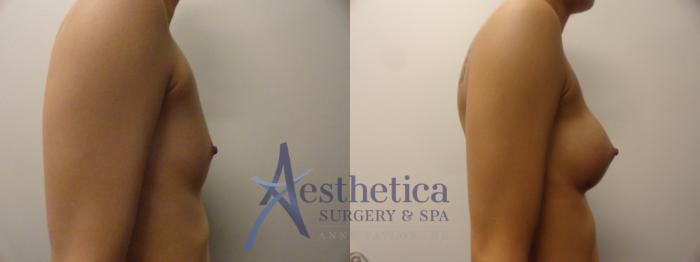 Breast Augmentation Case 388 Before & After View #4 | Columbus, OH | Aesthetica Surgery & Spa