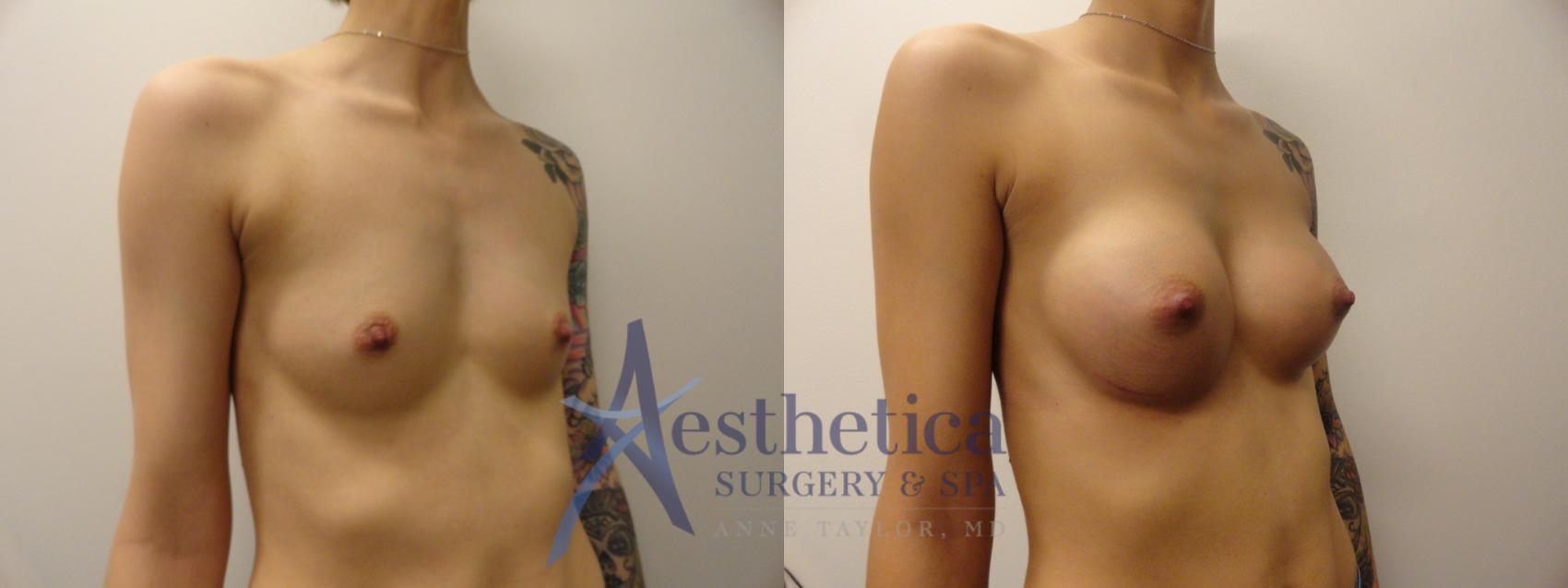 Breast Augmentation Case 388 Before & After View #5 | Worthington, OH | Aesthetica Surgery & Spa