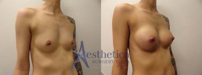 Breast Augmentation Case 388 Before & After View #5 | Columbus, OH | Aesthetica Surgery & Spa