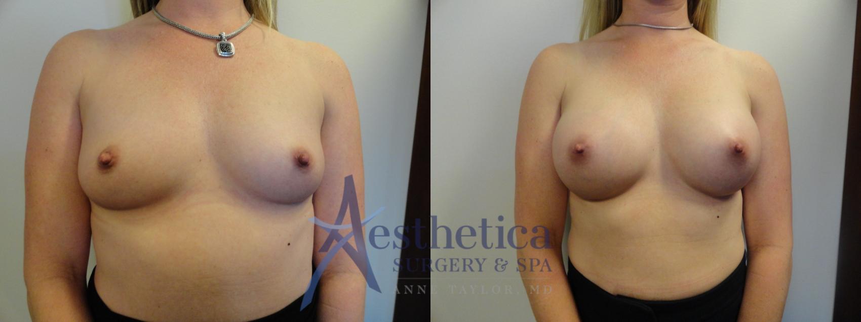 Breast Augmentation Case 389 Before & After View #1 | Worthington, OH | Aesthetica Surgery & Spa