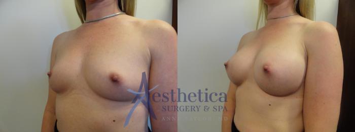 Breast Augmentation Case 389 Before & After View #2 | Columbus, OH | Aesthetica Surgery & Spa