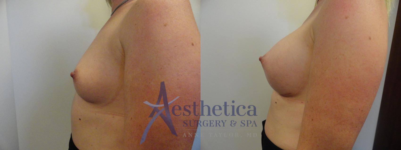 Breast Augmentation Case 389 Before & After View #3 | Worthington, OH | Aesthetica Surgery & Spa