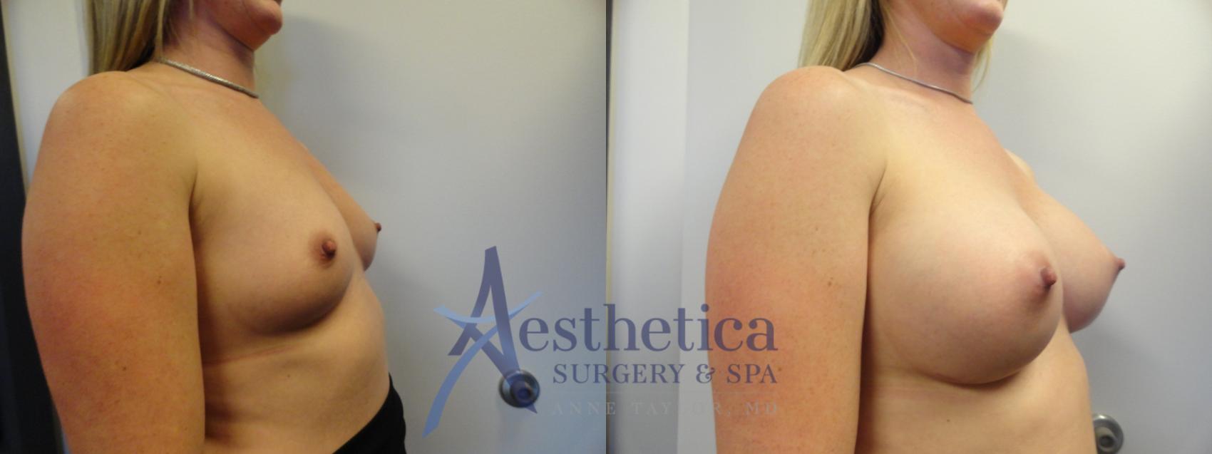 Breast Augmentation Case 389 Before & After View #4 | Worthington, OH | Aesthetica Surgery & Spa