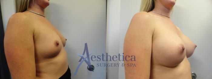 Breast Augmentation Case 389 Before & After View #4 | Columbus, OH | Aesthetica Surgery & Spa
