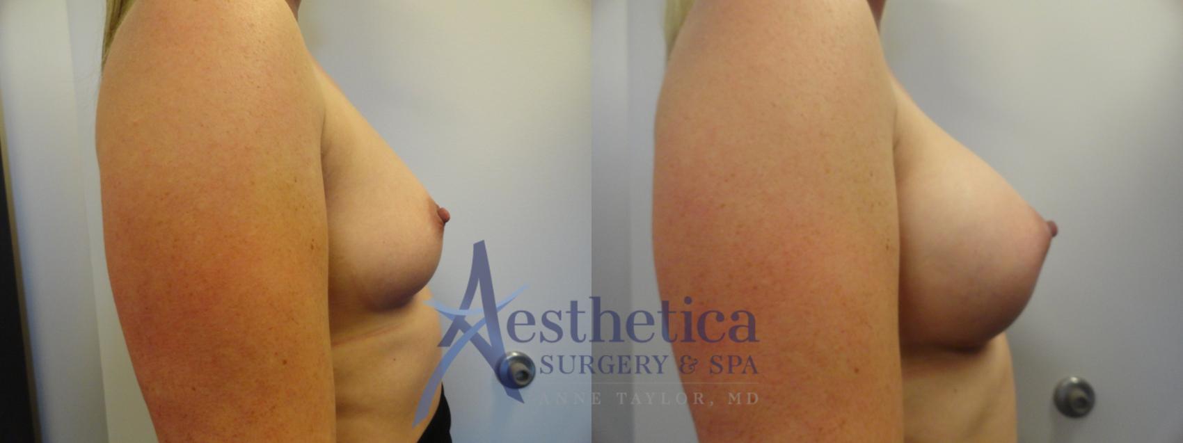 Breast Augmentation Case 389 Before & After View #5 | Worthington, OH | Aesthetica Surgery & Spa