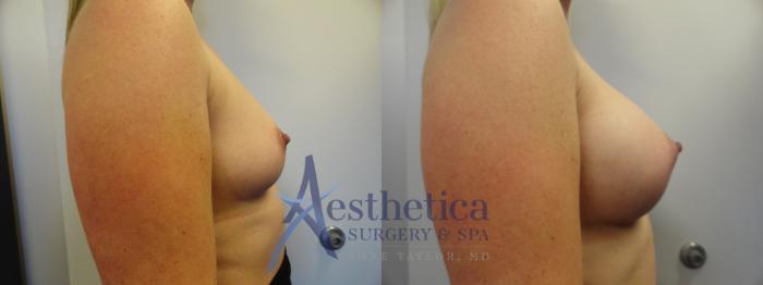Breast Augmentation Case 389 Before & After View #5 | Columbus, OH | Aesthetica Surgery & Spa