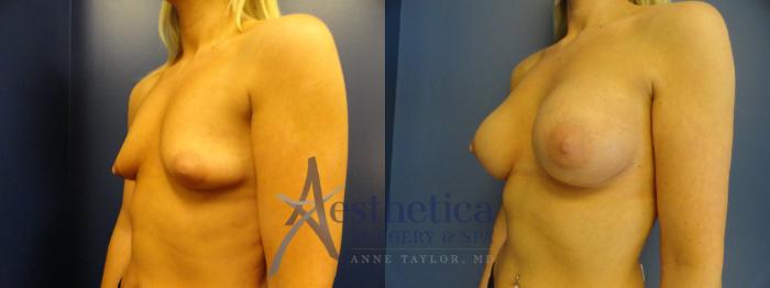 Breast Augmentation Case 390 Before & After View #2 | Columbus, OH | Aesthetica Surgery & Spa