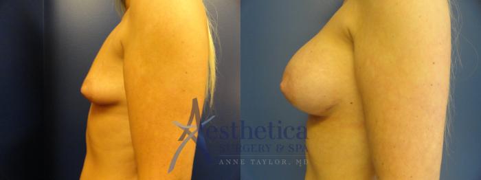 Breast Augmentation Case 390 Before & After View #3 | Columbus, OH | Aesthetica Surgery & Spa