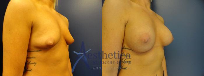 Breast Augmentation Case 390 Before & After View #4 | Columbus, OH | Aesthetica Surgery & Spa