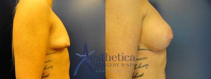 Breast Augmentation Case 390 Before & After View #5 | Columbus, OH | Aesthetica Surgery & Spa
