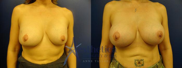 Breast Augmentation Case 391 Before & After View #1 | Columbus, OH | Aesthetica Surgery & Spa