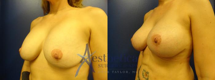 Breast Augmentation Case 391 Before & After View #2 | Columbus, OH | Aesthetica Surgery & Spa