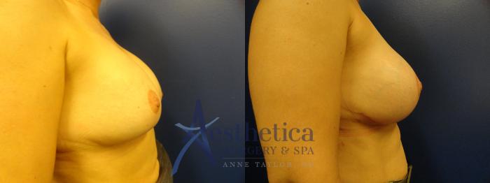 Breast Augmentation Case 391 Before & After View #3 | Columbus, OH | Aesthetica Surgery & Spa