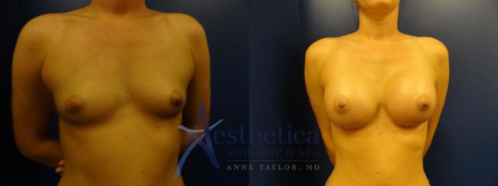 Breast Augmentation Case 392 Before & After View #1 | Columbus, OH | Aesthetica Surgery & Spa