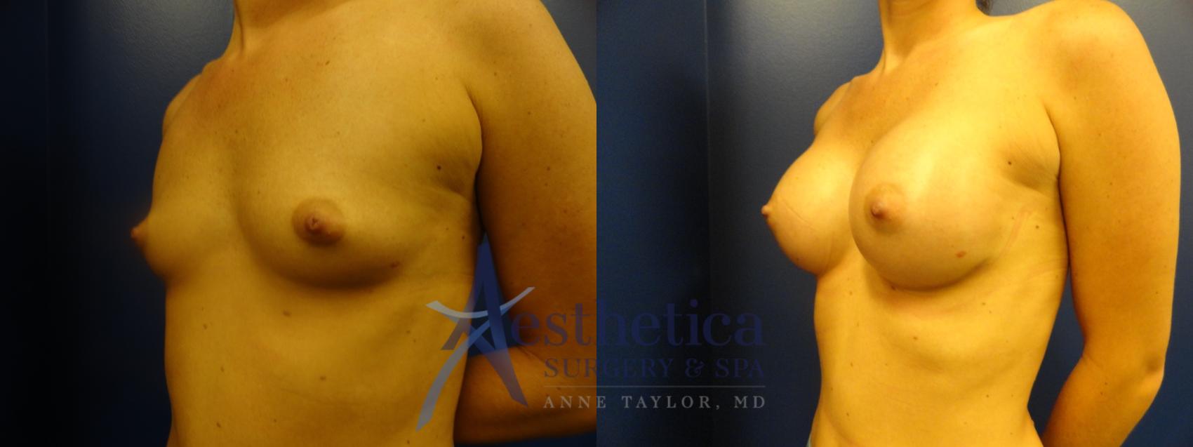 Breast Augmentation Case 392 Before & After View #2 | Columbus, OH | Aesthetica Surgery & Spa