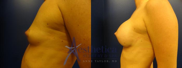 Breast Augmentation Case 392 Before & After View #3 | Columbus, OH | Aesthetica Surgery & Spa