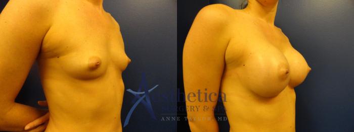 Breast Augmentation Case 392 Before & After View #4 | Columbus, OH | Aesthetica Surgery & Spa