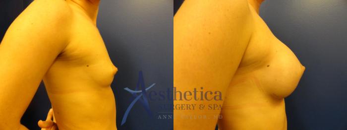 Breast Augmentation Case 392 Before & After View #5 | Columbus, OH | Aesthetica Surgery & Spa