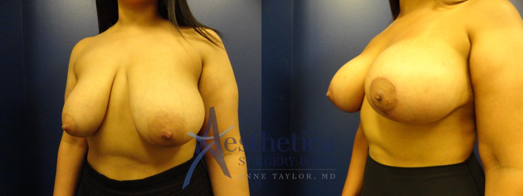 Breast Augmentation Case 393 Before & After View #2 | Columbus, OH | Aesthetica Surgery & Spa