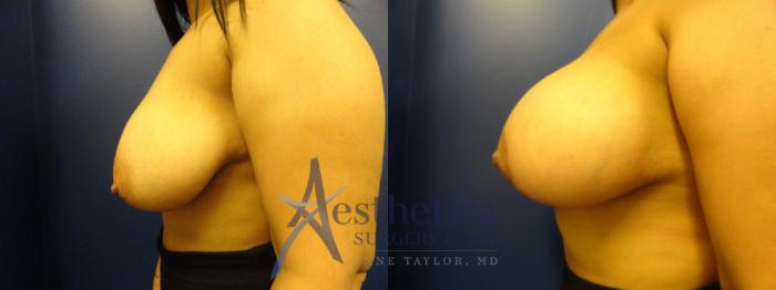 Breast Augmentation Case 393 Before & After View #3 | Columbus, OH | Aesthetica Surgery & Spa