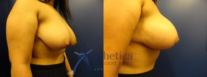 Breast Augmentation Case 393 Before & After View #4 | Columbus, OH | Aesthetica Surgery & Spa