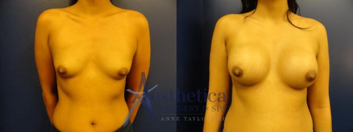 Breast Augmentation Case 394 Before & After View #1 | Columbus, OH | Aesthetica Surgery & Spa