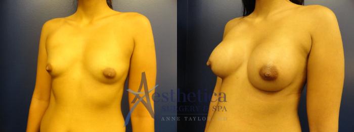 Breast Augmentation Case 394 Before & After View #2 | Columbus, OH | Aesthetica Surgery & Spa