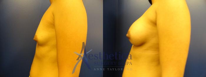 Breast Augmentation Case 394 Before & After View #3 | Columbus, OH | Aesthetica Surgery & Spa