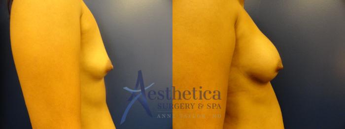 Breast Augmentation Case 394 Before & After View #4 | Columbus, OH | Aesthetica Surgery & Spa