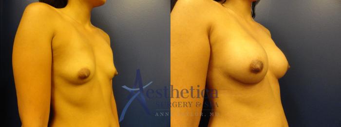 Breast Augmentation Case 394 Before & After View #5 | Columbus, OH | Aesthetica Surgery & Spa
