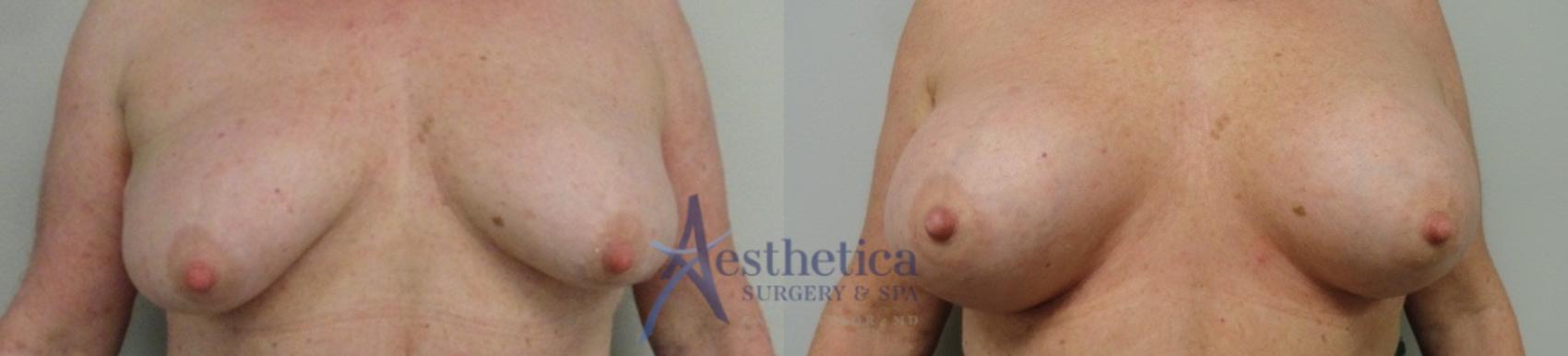 Breast Augmentation Case 42 Before & After View #1 | Columbus, OH | Aesthetica Surgery & Spa