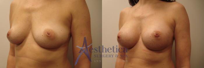 Breast Augmentation Case 433 Before & After Left Oblique | Columbus, OH | Aesthetica Surgery & Spa