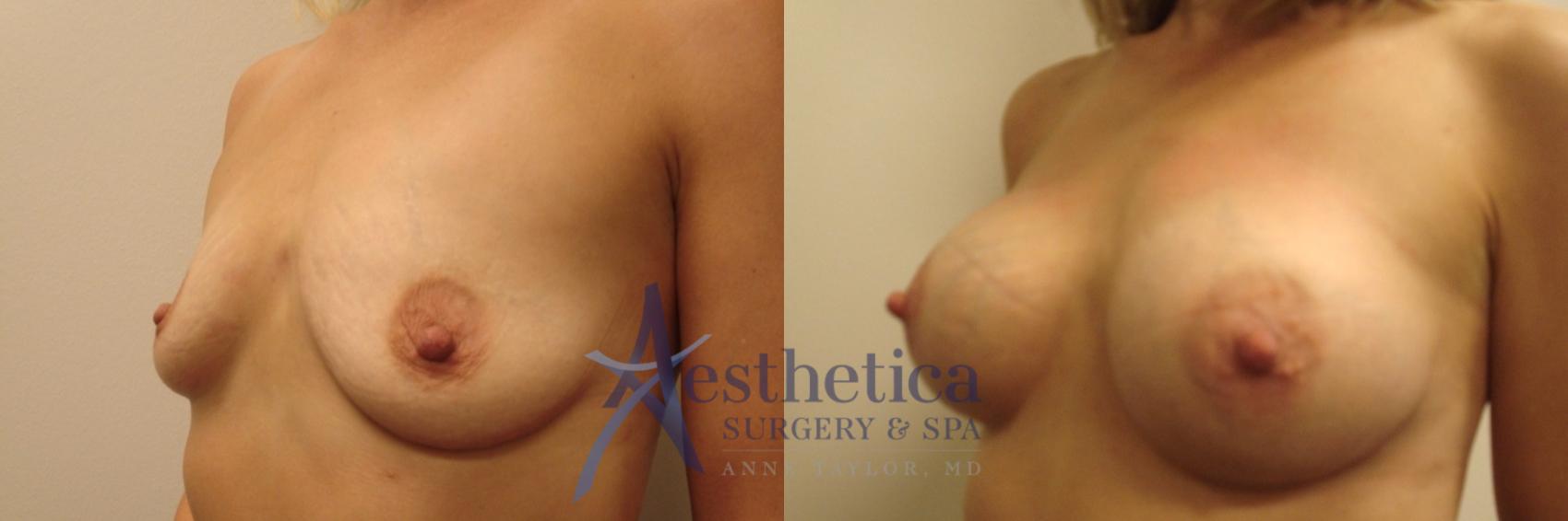 Breast Augmentation Case 434 Before & After Left Oblique | Worthington, OH | Aesthetica Surgery & Spa