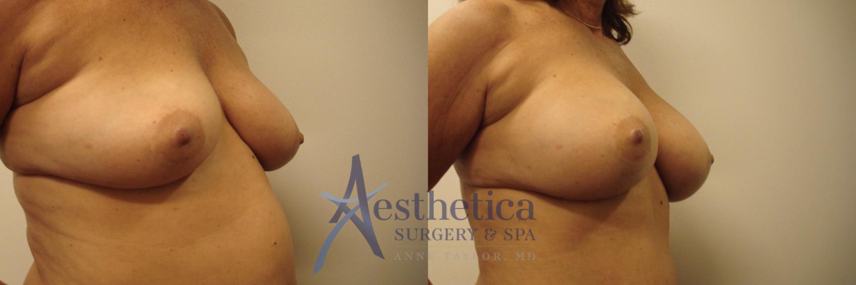 Breast Augmentation Case 438 Before & After Right Side | Worthington, OH | Aesthetica Surgery & Spa
