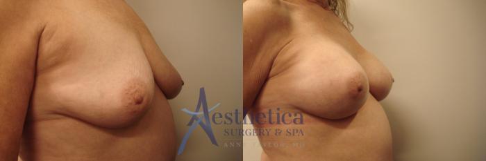 Breast Augmentation Case 448 Before & After Right Oblique | Columbus, OH | Aesthetica Surgery & Spa