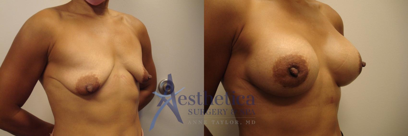Breast Augmentation Case 454 Before & After Right Oblique | Worthington, OH | Aesthetica Surgery & Spa