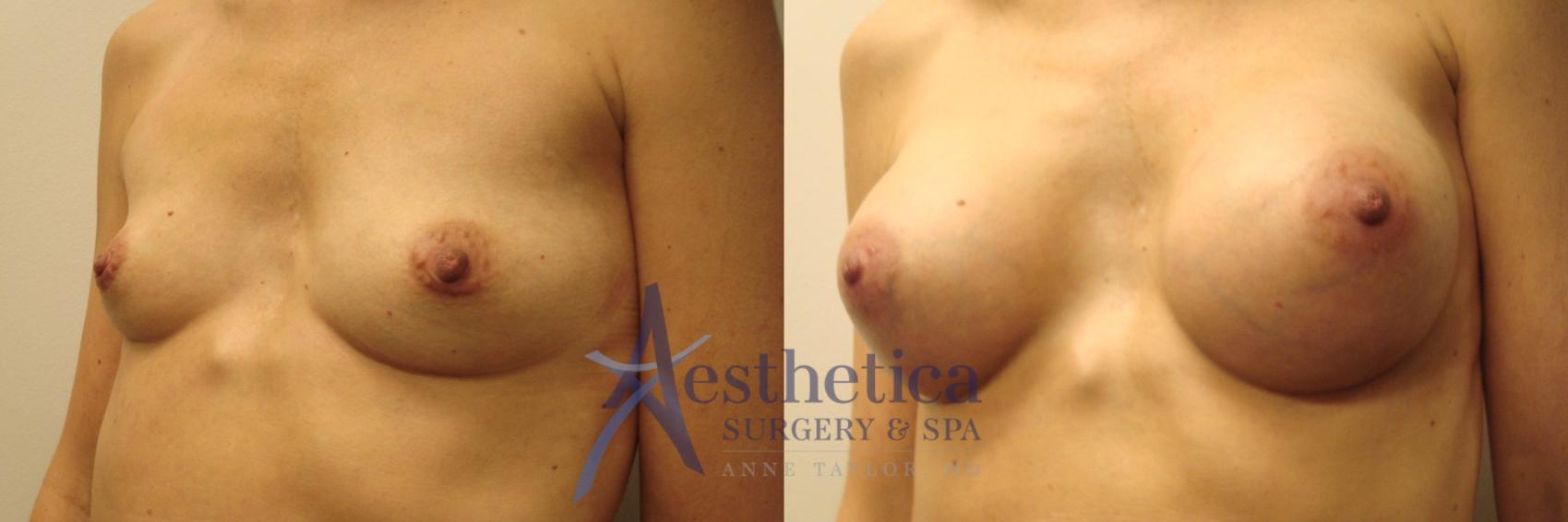 Breast Augmentation Case 468 Before & After Left Oblique | Columbus, OH | Aesthetica Surgery & Spa