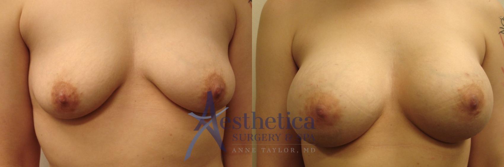 Breast Augmentation Case 471 Before & After Front | Columbus, OH | Aesthetica Surgery & Spa