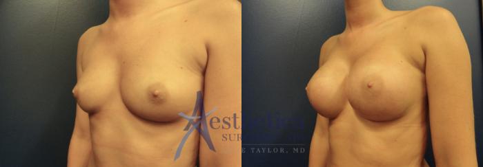 Breast Augmentation Case 48 Before & After View #1 | Columbus, OH | Aesthetica Surgery & Spa