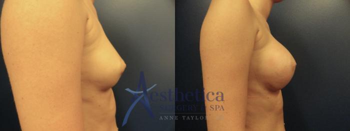 Breast Augmentation Case 48 Before & After View #2 | Columbus, OH | Aesthetica Surgery & Spa