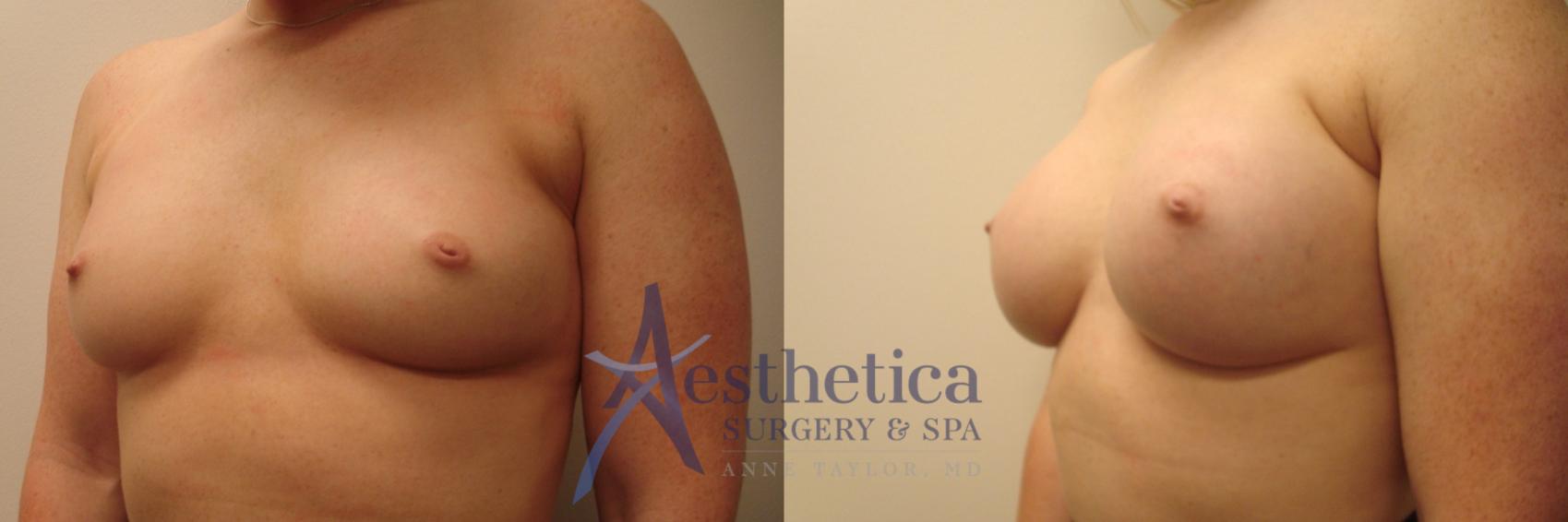 Breast Augmentation Case 482 Before & After Left Oblique | Worthington, OH | Aesthetica Surgery & Spa