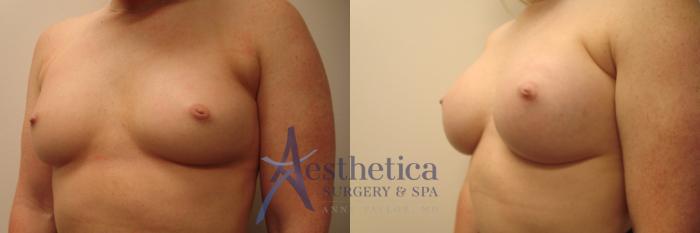 Breast Augmentation Case 482 Before & After Left Oblique | Columbus, OH | Aesthetica Surgery & Spa