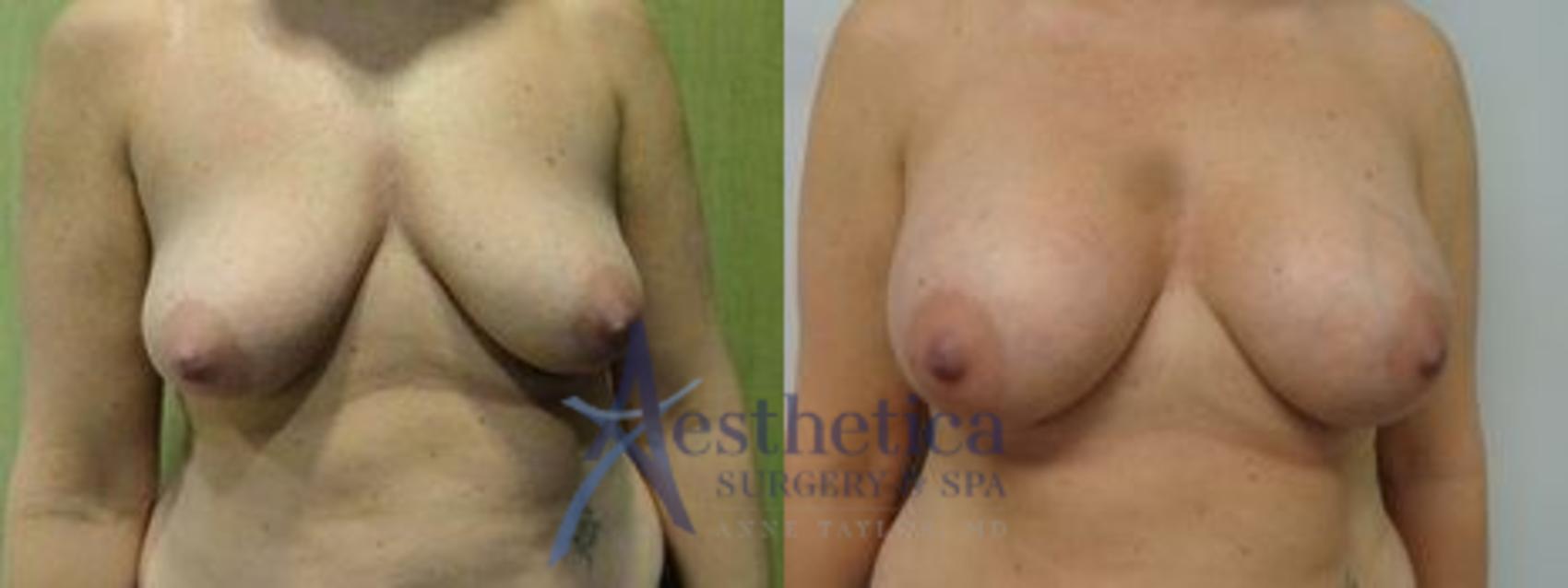 Breast Augmentation Case 5 Before & After View #1 | Columbus, OH | Aesthetica Surgery & Spa