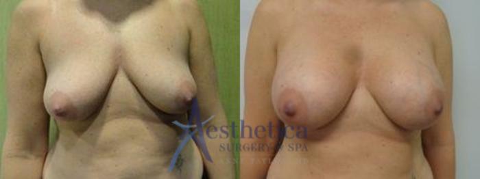 Breast Augmentation Case 5 Before & After View #1 | Columbus, OH | Aesthetica Surgery & Spa
