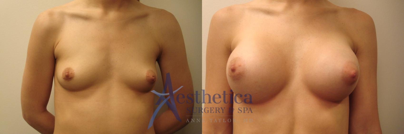 Breast Augmentation Case 506 Before & After Front | Worthington, OH | Aesthetica Surgery & Spa