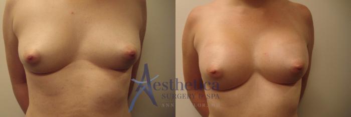 Breast Augmentation Case 513 Before & After Front | Columbus, OH | Aesthetica Surgery & Spa